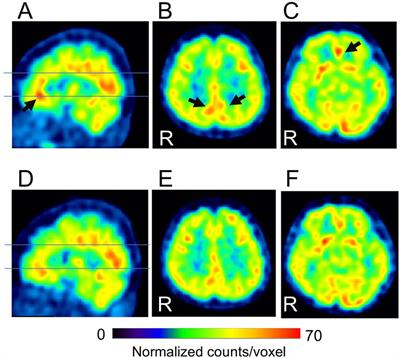 Precuneal hyperperfusion in patients with attention-deficit/hyperactivity disorder-comorbid nociplastic pain